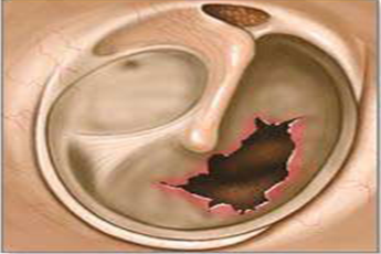 鼓膜穿孔是否構成輕傷？